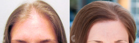 greffes de cheveux femme