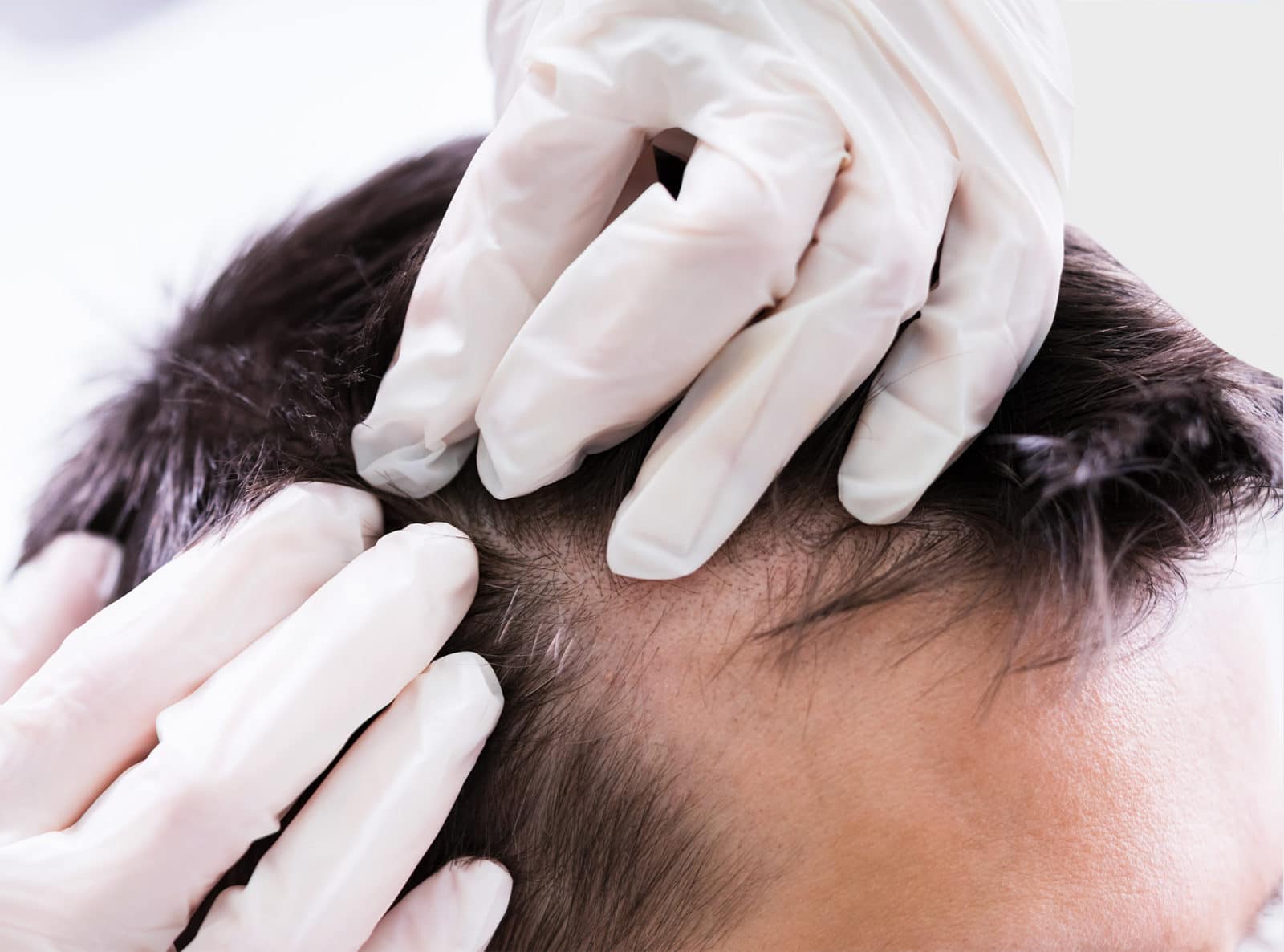 La greffe FUE (Follicular Unit Extraction) pour corriger l’alopécie à Paris