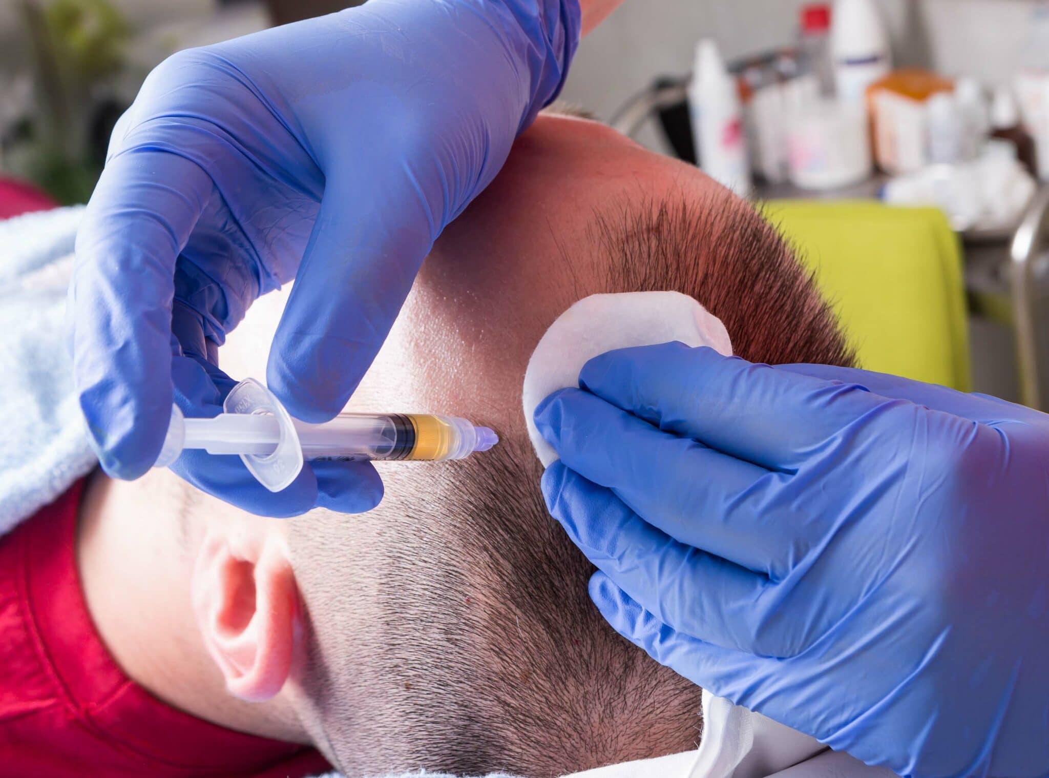 PRP Cheveux à Paris : Séances, résultats | Paris 16eme, Tocadero | Centre de Greffe de cheveux